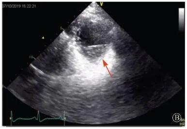 【惊人】基因检测解决心血管疾病诊断和治疗疑难