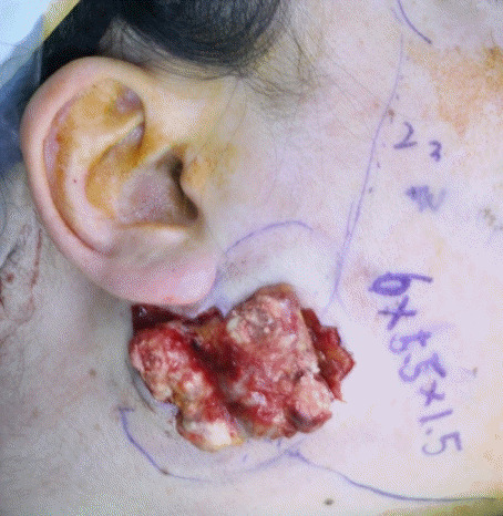 【佳学基因检测】巨大毛母质瘤的基因检测案例