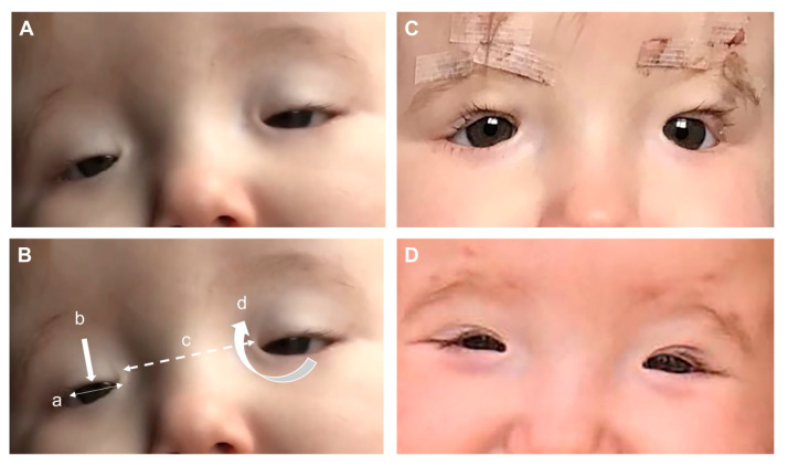 【佳学基因检测】睑裂狭小综合征Blepharophimosis syndrome基因解码、基因检测 【佳学基因检测】睑裂狭小综合征Blepharophimosis syndrome基因解码、基因检测