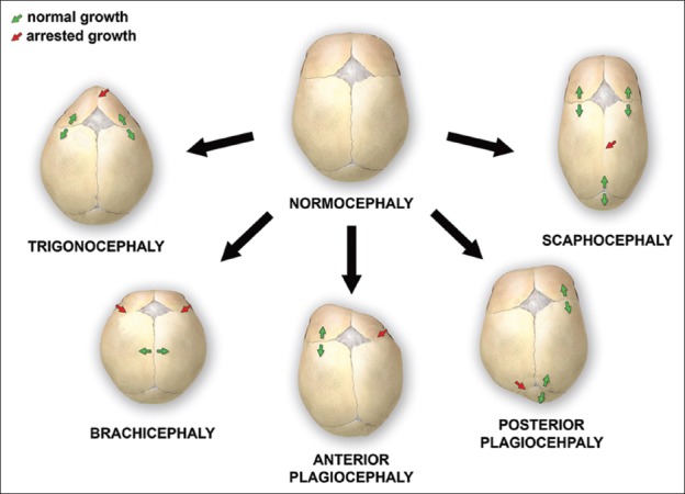 【佳学基因检测】囟门或颅缝异常基因检测 Abnormality of the fontanelles or cranial sutures