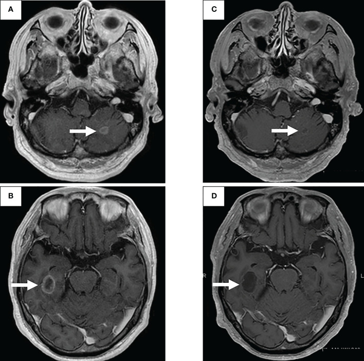 【佳学基因检测】肺癌靶向药物基因检测为什么要包含RET重排 【佳学基因检测】肺癌靶向药物基因检测为什么要包含RET重排