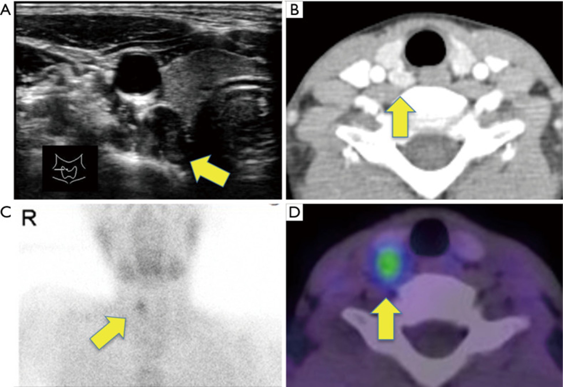 【佳学基因检测】原发性甲状旁腺功能亢进及钙代谢基因解码基因检测 【佳学基因检测】原发性甲状旁腺功能亢进及钙代谢基因解码基因检测